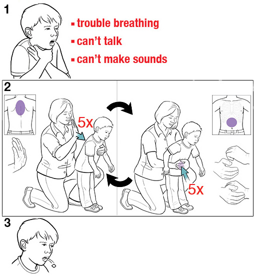 海姆立克急救法儿童.png